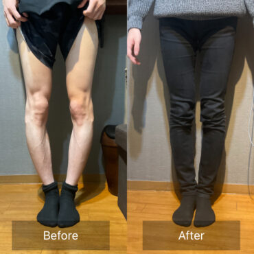 【Before→After】O脚矯正でここまで変わる！驚きの変化を公開
