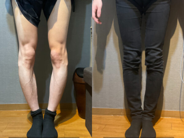 【Before→After】O脚矯正でここまで変わる！驚きの変化を公開