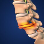 辷り症による腰痛やしびれでお悩みの方へ